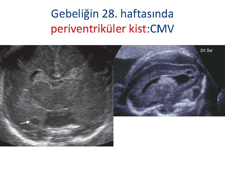 Gebeliğin 28. haftasında periventriküler kist: CMV 