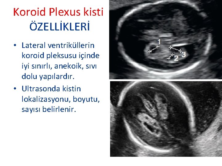Koroid Plexus kisti ÖZELLİKLERİ • Lateral ventriküllerin koroid pleksusu içinde iyi sınırlı, anekoik, sıvı