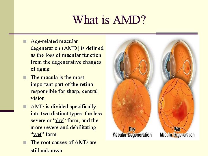 What is AMD? n Age-related macular degeneration (AMD) is defined as the loss of