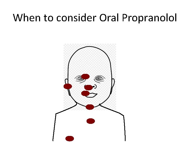 When to consider Oral Propranolol When to consider Oral Propranolol