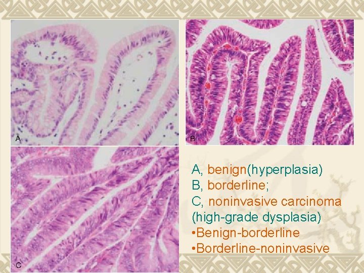 A, benign(hyperplasia) B, borderline; C, noninvasive carcinoma (high-grade dysplasia) • Benign-borderline • Borderline-noninvasive 