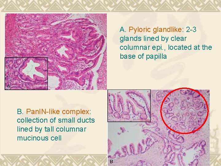 A. Pyloric glandlike: 2 -3 glands lined by clear columnar epi. , located at