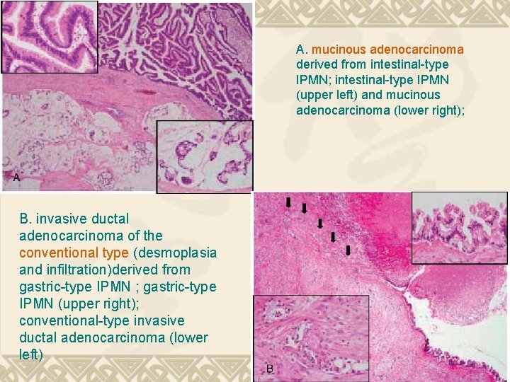 A. mucinous adenocarcinoma derived from intestinal-type IPMN; intestinal-type IPMN (upper left) and mucinous adenocarcinoma