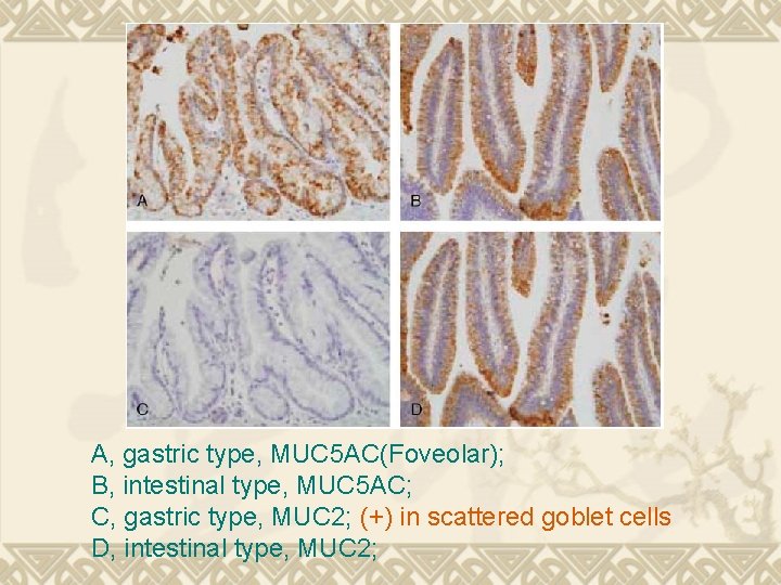 A, gastric type, MUC 5 AC(Foveolar); B, intestinal type, MUC 5 AC; C, gastric