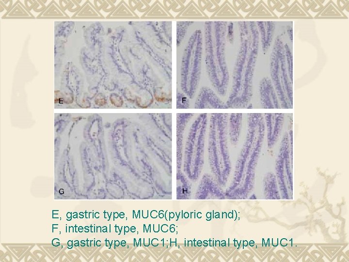 E, gastric type, MUC 6(pyloric gland); F, intestinal type, MUC 6; G, gastric type,