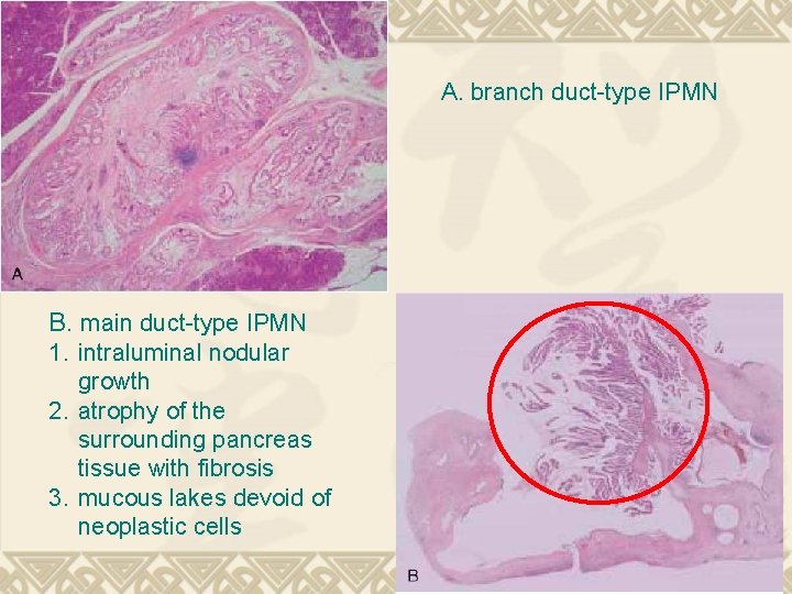 A. branch duct-type IPMN B. main duct-type IPMN 1. intraluminal nodular growth 2. atrophy