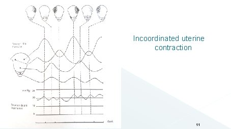 Incoordinated uterine contraction 11 Incoordinated uterine contraction 11