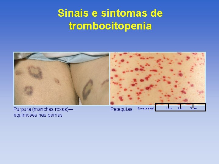 Sinais e sintomas de trombocitopenia Purpura (manchas roxas)— equimoses nas pernas Petequias Escala atual: