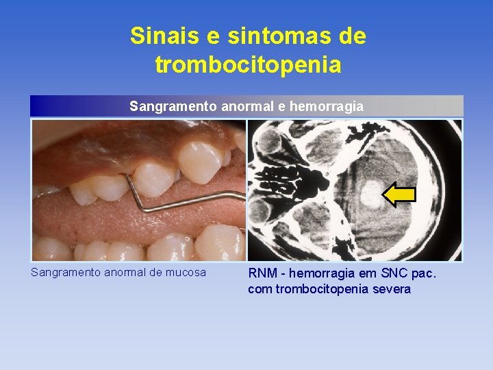 Sinais e sintomas de trombocitopenia Sangramento anormal e hemorragia Sangramento anormal de mucosa RNM