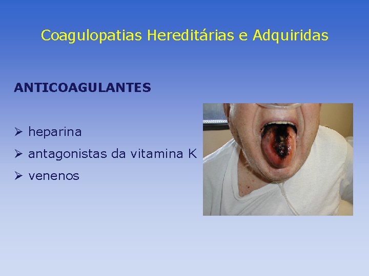 Coagulopatias Hereditárias e Adquiridas ANTICOAGULANTES Ø heparina Ø antagonistas da vitamina K Ø venenos