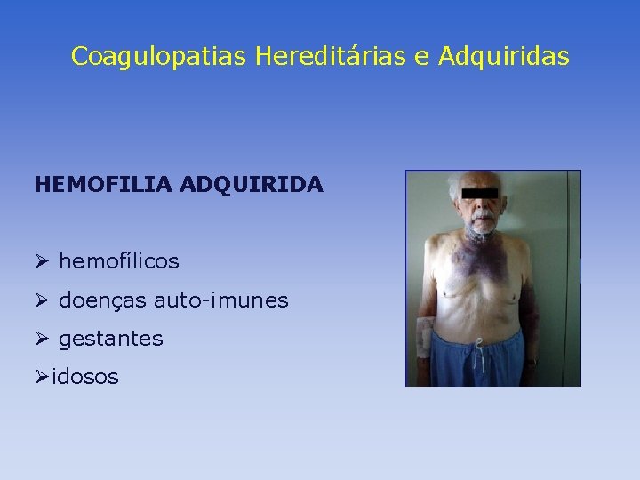 Coagulopatias Hereditárias e Adquiridas HEMOFILIA ADQUIRIDA Ø hemofílicos Ø doenças auto-imunes Ø gestantes Øidosos