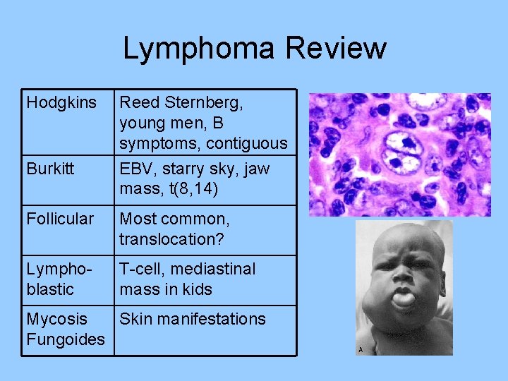 Lymphoma Review Hodgkins Burkitt Reed Sternberg, young men, B symptoms, contiguous EBV, starry sky, Lymphoma Review Hodgkins Burkitt Reed Sternberg, young men, B symptoms, contiguous EBV, starry sky,