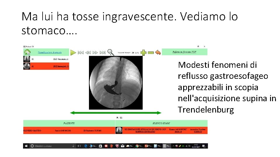 Ma lui ha tosse ingravescente. Vediamo lo stomaco…. Modesti fenomeni di reflusso gastroesofageo apprezzabili