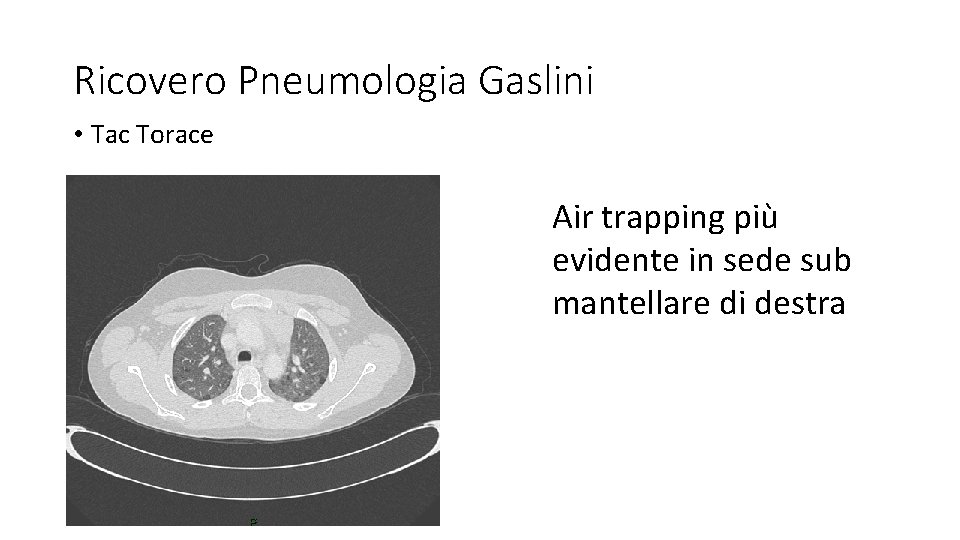 Ricovero Pneumologia Gaslini • Tac Torace Air trapping più evidente in sede sub mantellare