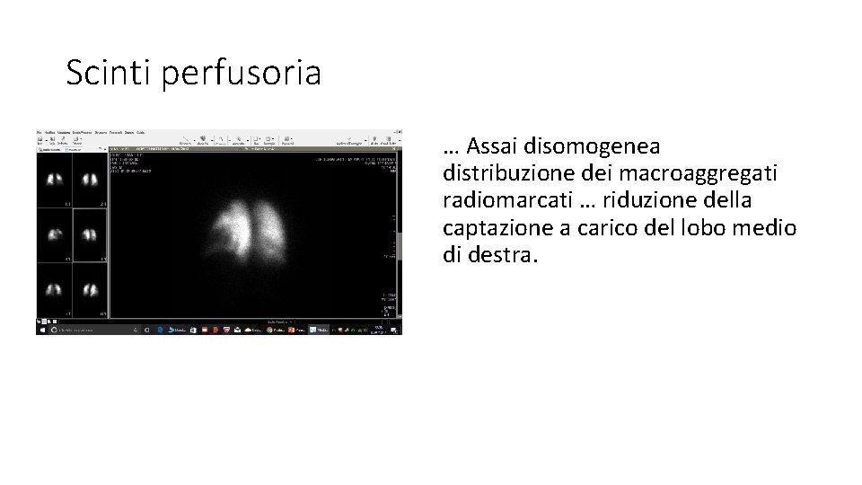 Scinti perfusoria … Assai disomogenea distribuzione dei macroaggregati radiomarcati … riduzione della captazione a