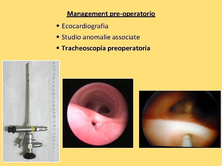 Management pre-operatorio § Ecocardiografia § Studio anomalie associate § Tracheoscopia preoperatoria 