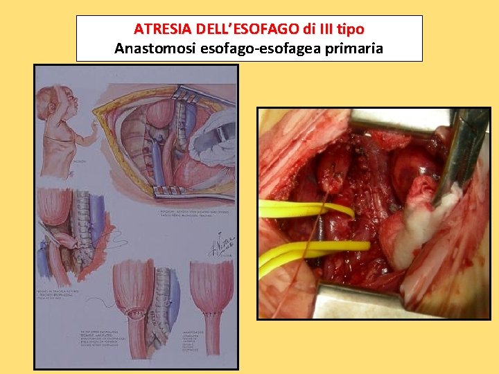 ATRESIA DELL’ESOFAGO di III tipo Anastomosi esofago-esofagea primaria 