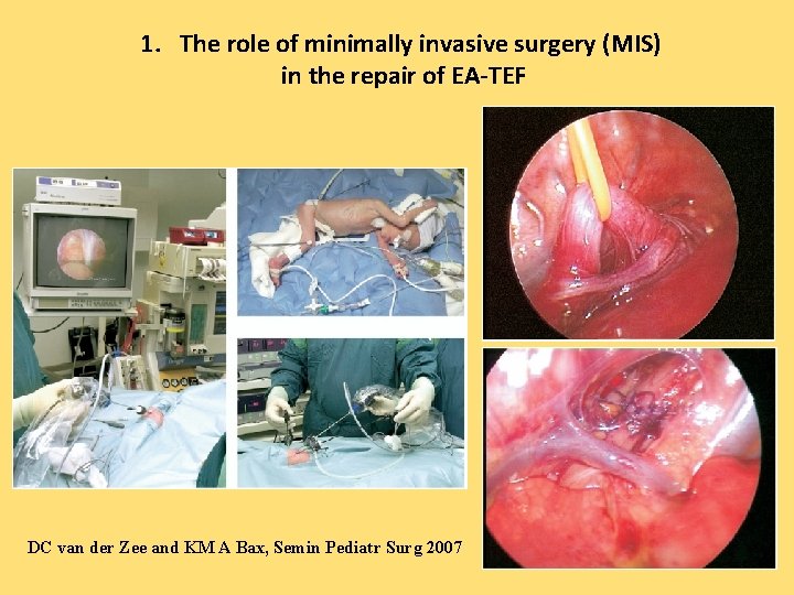 1. The role of minimally invasive surgery (MIS) in the repair of EA-TEF DC