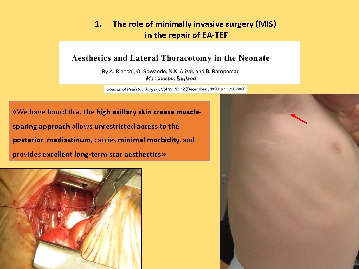 1. The role of minimally invasive surgery (MIS) in the repair of EA-TEF «We
