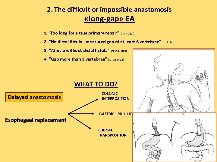 2. The difficult or impossible anastomosis «long-gap» EA 1. “Too long for a true