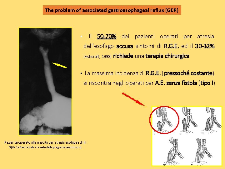 The problem of associated gastroesophageal reflux (GER) Il 50 -70% dei pazienti operati per