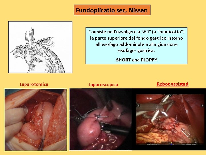 Fundoplicatio sec. Nissen Consiste nell’avvolgere a 360° (a “manicotto”) la parte superiore del fondo