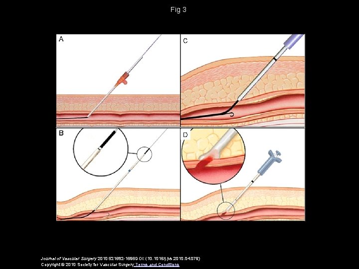 Fig 3 Journal of Vascular Surgery 2010 521682 -1696 DOI: (10. 1016/j. jvs. 2010.