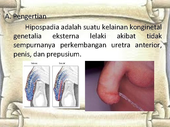 A. Pengertian Hipospadia adalah suatu kelainan konginetal genetalia eksterna lelaki akibat tidak sempurnanya perkembangan A. Pengertian Hipospadia adalah suatu kelainan konginetal genetalia eksterna lelaki akibat tidak sempurnanya perkembangan