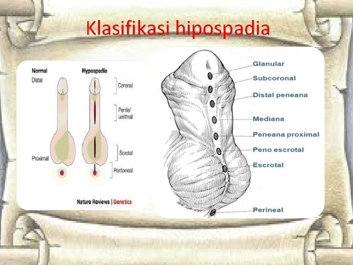 Klasifikasi hipospadia Klasifikasi hipospadia