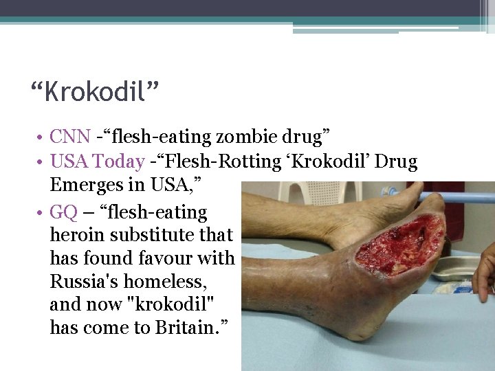 “Krokodil” • CNN -“flesh-eating zombie drug” • USA Today -“Flesh-Rotting ‘Krokodil’ Drug Emerges in