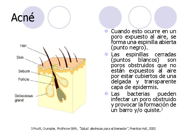 Acné l Cuando esto ocurre en un poro expuesto al aire, se forma una Acné l Cuando esto ocurre en un poro expuesto al aire, se forma una