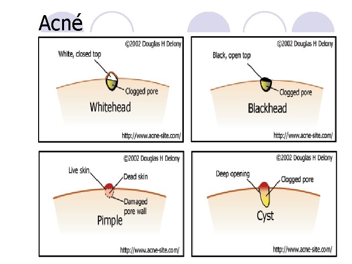 Acné Acné
