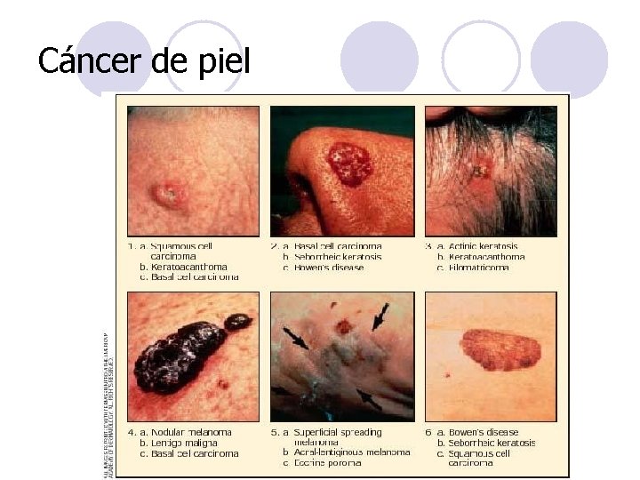 Cáncer de piel Cáncer de piel