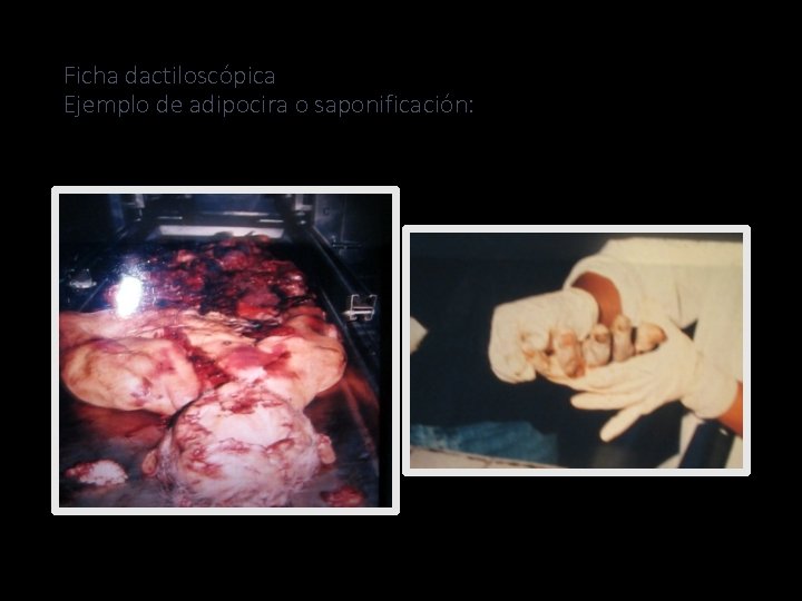 Ficha dactiloscópica Ejemplo de adipocira o saponificación: 43 