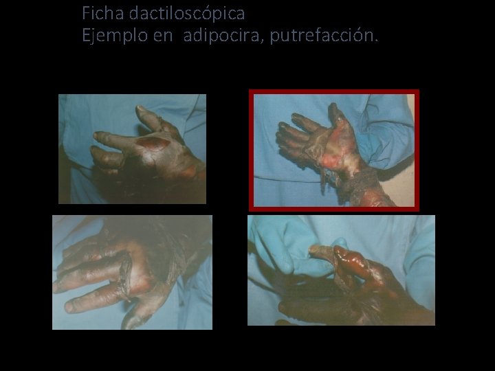 Ficha dactiloscópica Ejemplo en adipocira, putrefacción. 45 