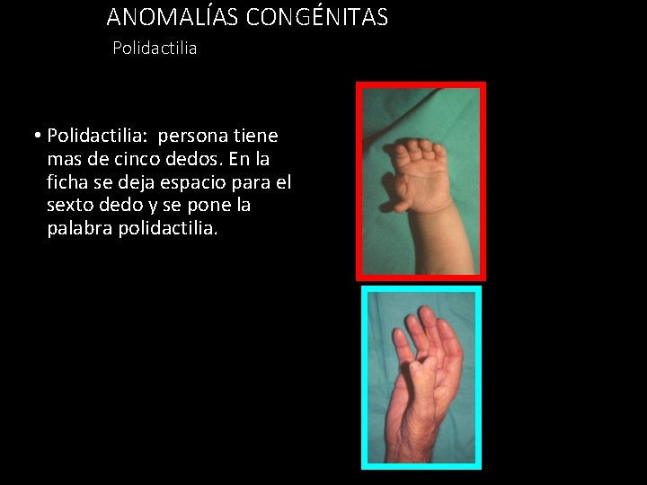 ANOMALÍAS CONGÉNITAS Polidactilia • Polidactilia: persona tiene mas de cinco dedos. En la ficha