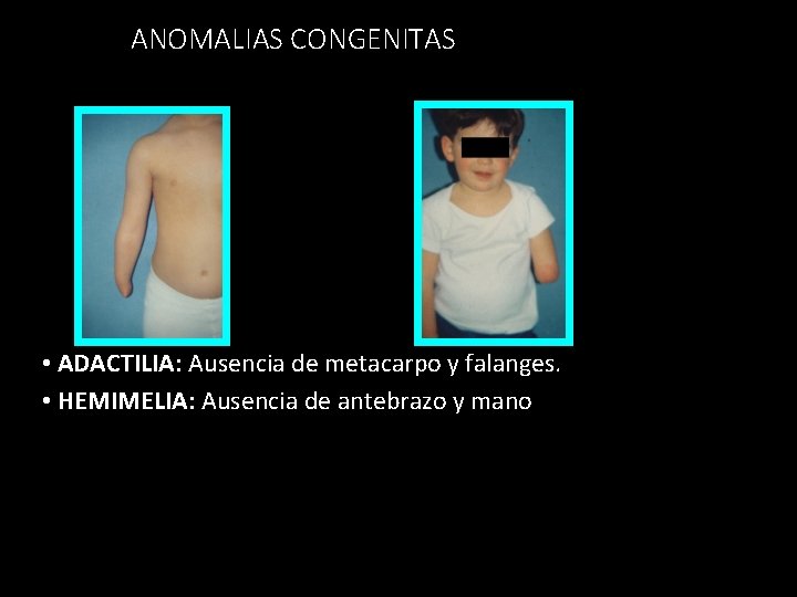 ANOMALIAS CONGENITAS • ADACTILIA: Ausencia de metacarpo y falanges. • HEMIMELIA: Ausencia de antebrazo