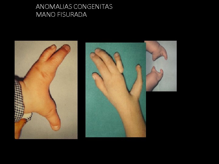 ANOMALIAS CONGENITAS MANO FISURADA 53 