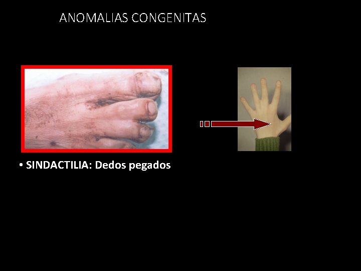 ANOMALIAS CONGENITAS • SINDACTILIA: Dedos pegados 54 