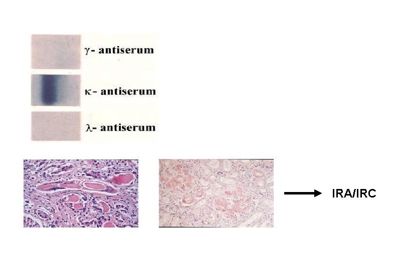 Le discrasie plasmacellulari Discrasie plasmacellulari I Gammopatia
