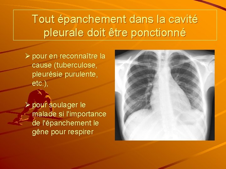 Tout épanchement dans la cavité pleurale doit être ponctionné Ø pour en reconnaître la