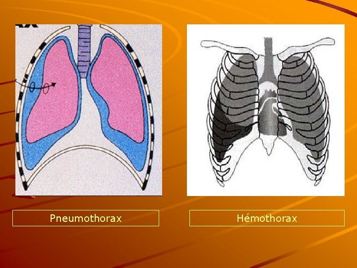 Pneumothorax Hémothorax 