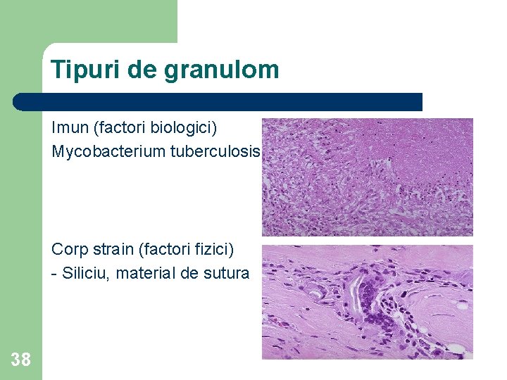 Tipuri de granulom Imun (factori biologici) Mycobacterium tuberculosis Corp strain (factori fizici) - Siliciu,