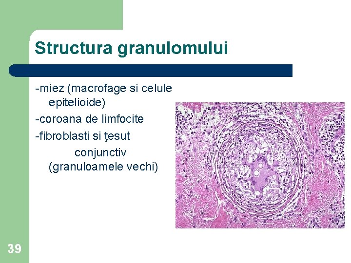 Structura granulomului -miez (macrofage si celule epitelioide) -coroana de limfocite -fibroblasti si ţesut conjunctiv