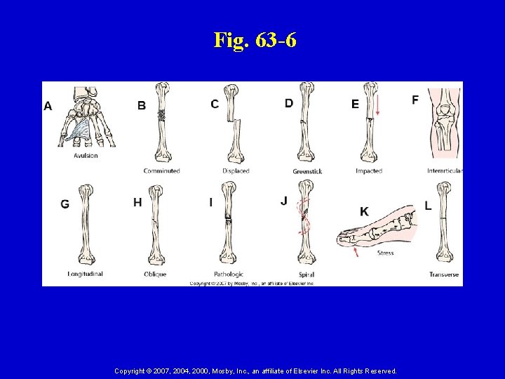 Fig. 63 -6 Copyright © 2007, 2004, 2000, Mosby, Inc. , an affiliate of