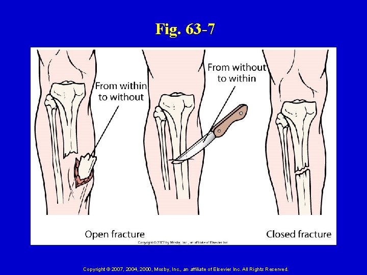 Fig. 63 -7 Copyright © 2007, 2004, 2000, Mosby, Inc. , an affiliate of