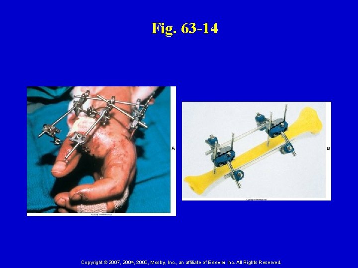 Fig. 63 -14 Copyright © 2007, 2004, 2000, Mosby, Inc. , an affiliate of