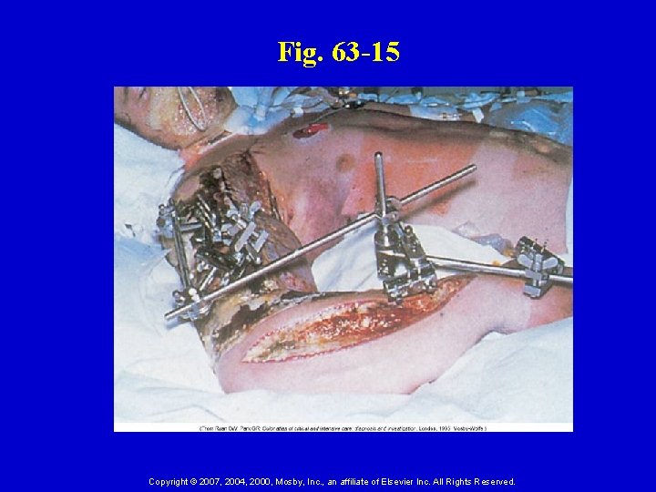Fig. 63 -15 Copyright © 2007, 2004, 2000, Mosby, Inc. , an affiliate of