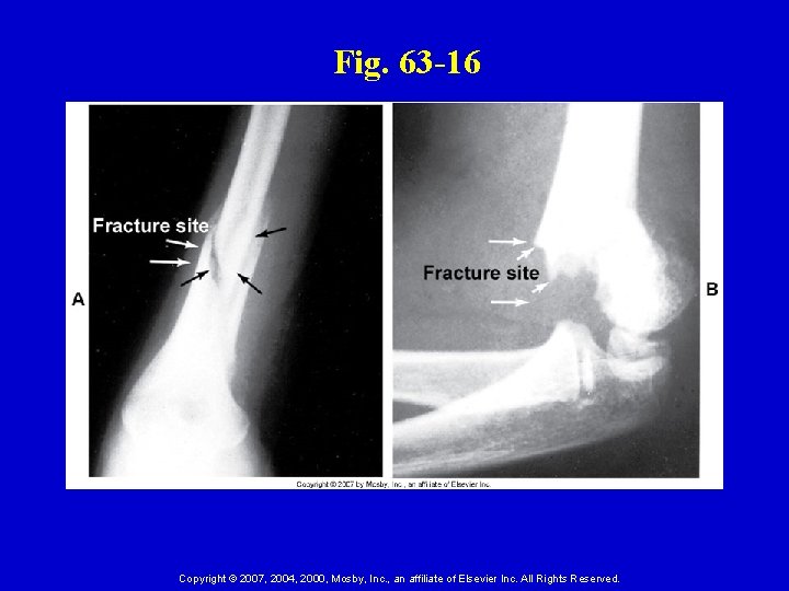 Fig. 63 -16 Copyright © 2007, 2004, 2000, Mosby, Inc. , an affiliate of