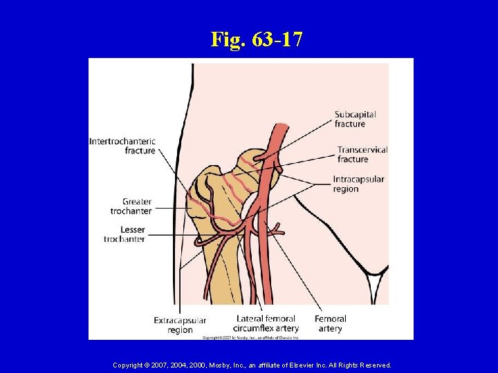 Fig. 63 -17 Copyright © 2007, 2004, 2000, Mosby, Inc. , an affiliate of